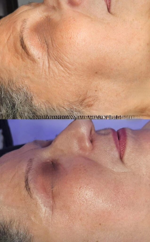 avant après soin anti age nathdermo